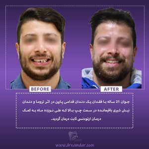 نمونه قبل و بعد دندان ارتودونسی شده 1
