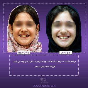 نمونه قبل و بعد دندان ارتودونسی شده 3