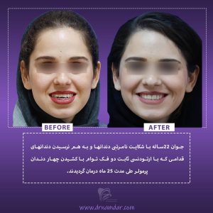 نمونه قبل و بعد دندان ارتودونسی شده 4