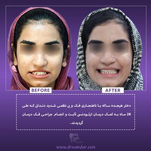 نمونه قبل و بعد دندان ارتودونسی شده 5