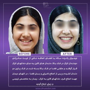 نمونه قبل و بعد دندان ارتودونسی شده 6