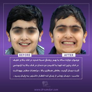 نمونه قبل و بعد دندان ارتودونسی شده 7