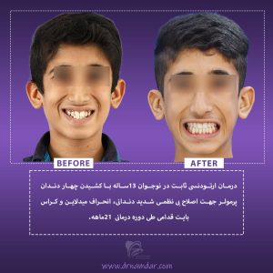 نمونه قبل و بعد دندان ارتودونسی شده 8
